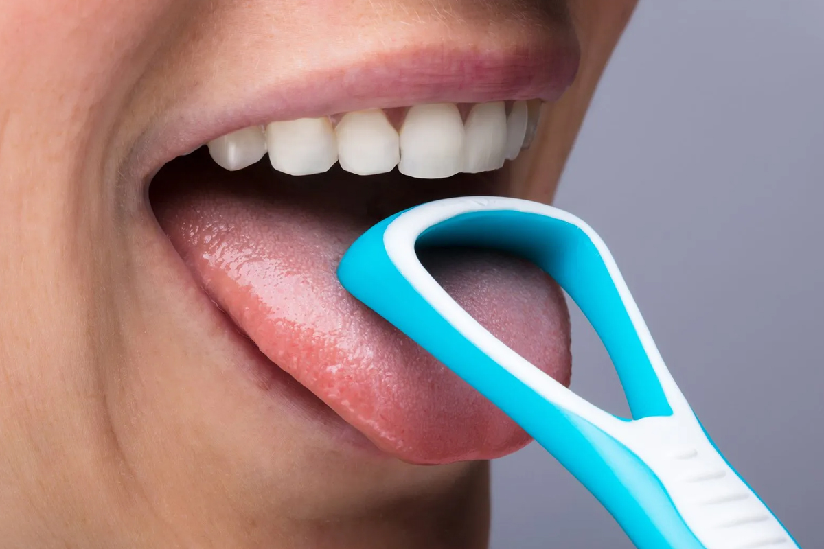 Tongue Scraping: the Forgotten Frontier of Dental Hygiene