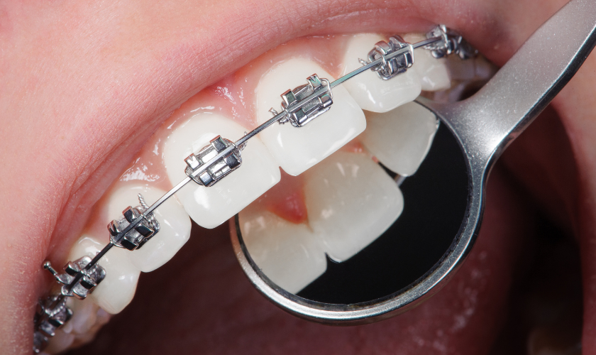 Teeth and Invisalign Hygiene After Eating: Expert Cleaning Tips