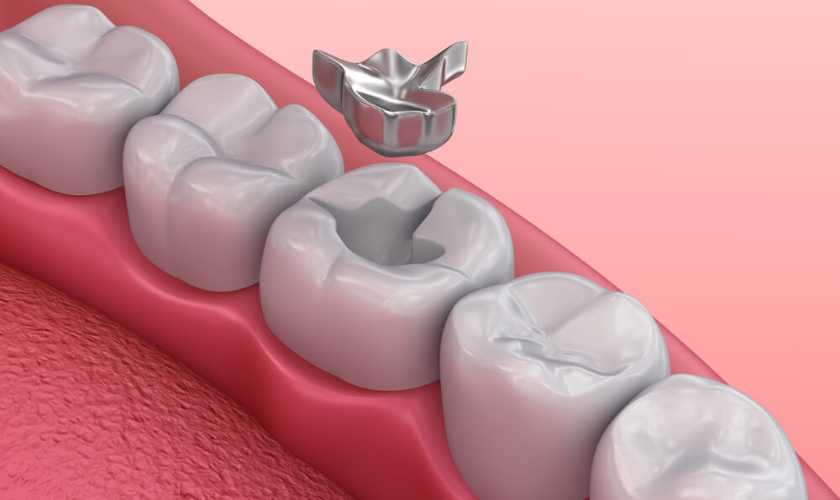 How to Ease Discomfort from a Lost Filling or Crown Before Your Dentist Visit