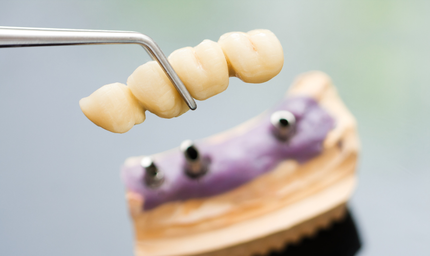 dental bridges your pathway to perfect smile