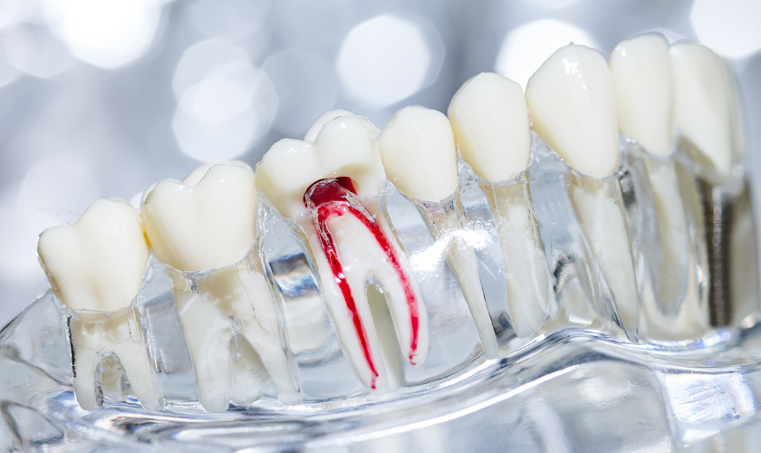 root canal therapy stuart