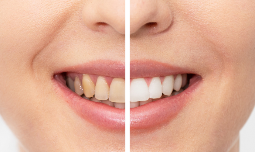 teeth whitening stuart