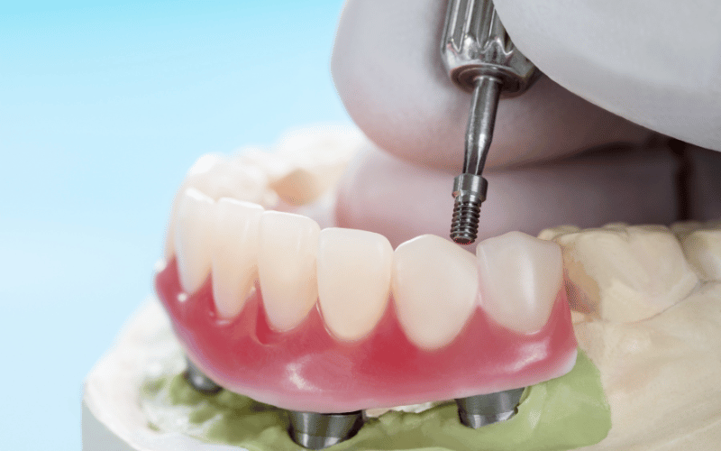 Dental Implants Can Enhance Your Chewing Ability