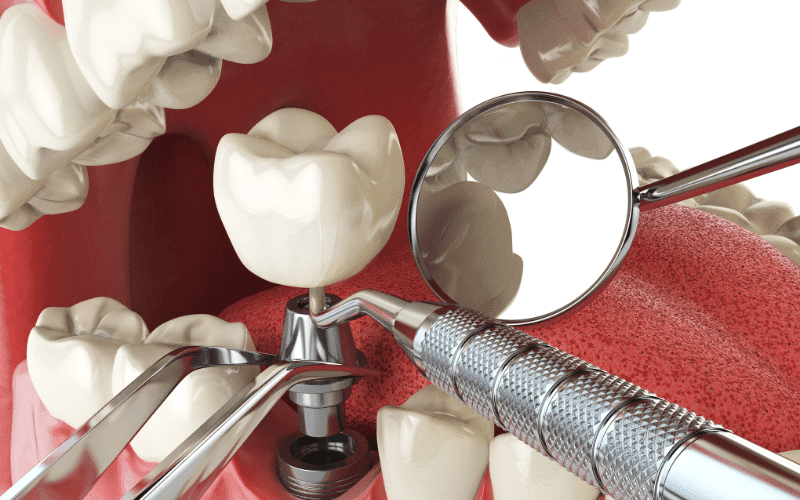 Dental Implants