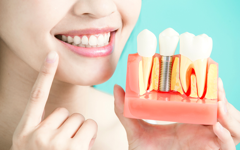 7 Signs Your Dental Implants May Be in Trouble