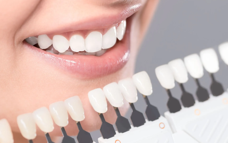 Time to change your dental veneers