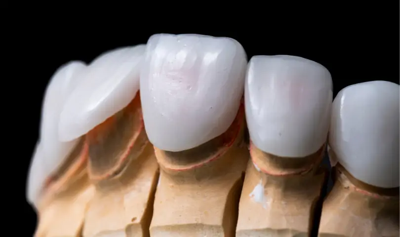 The Key Components Of Dental Veneers
