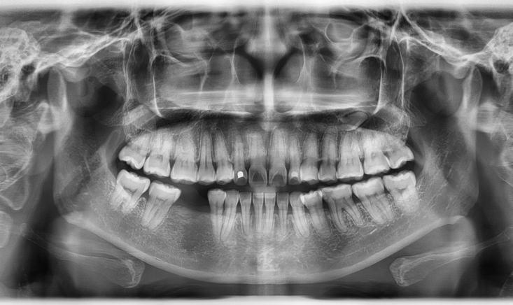 Dental X-Rays: Are They Necessary and How Safe Are They?