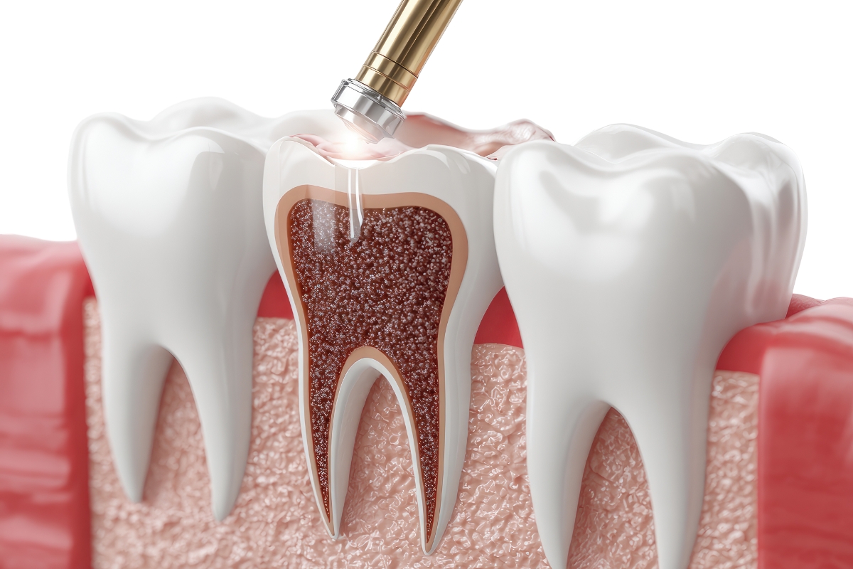 root-canal-therapy-in-Stuart